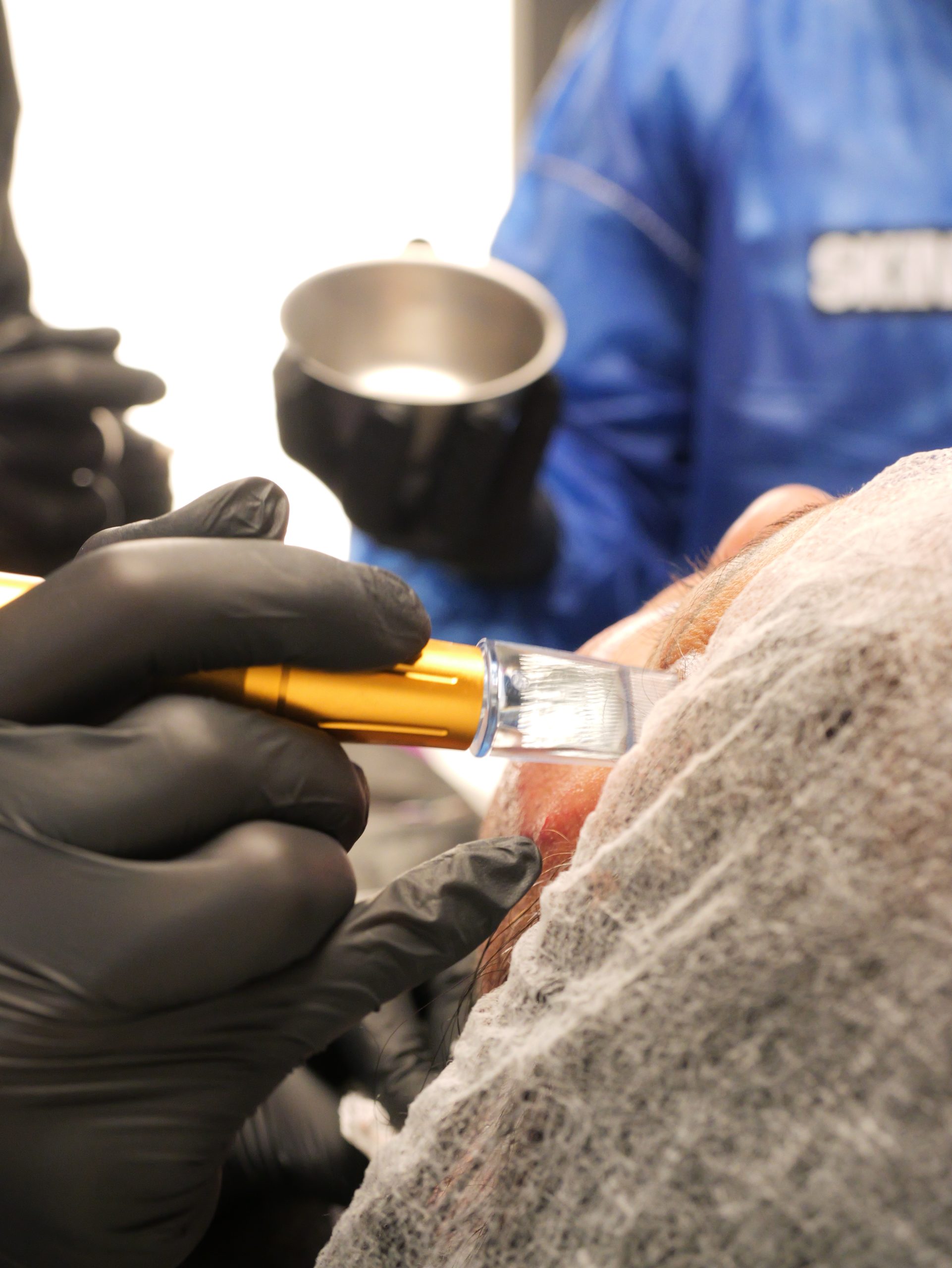Peeling SKIMS - Dr. José Henrique - mentoria - curso - imersao, Peeling SKIMS - Dr. José Henrique - mentoria - curso - imersao 1