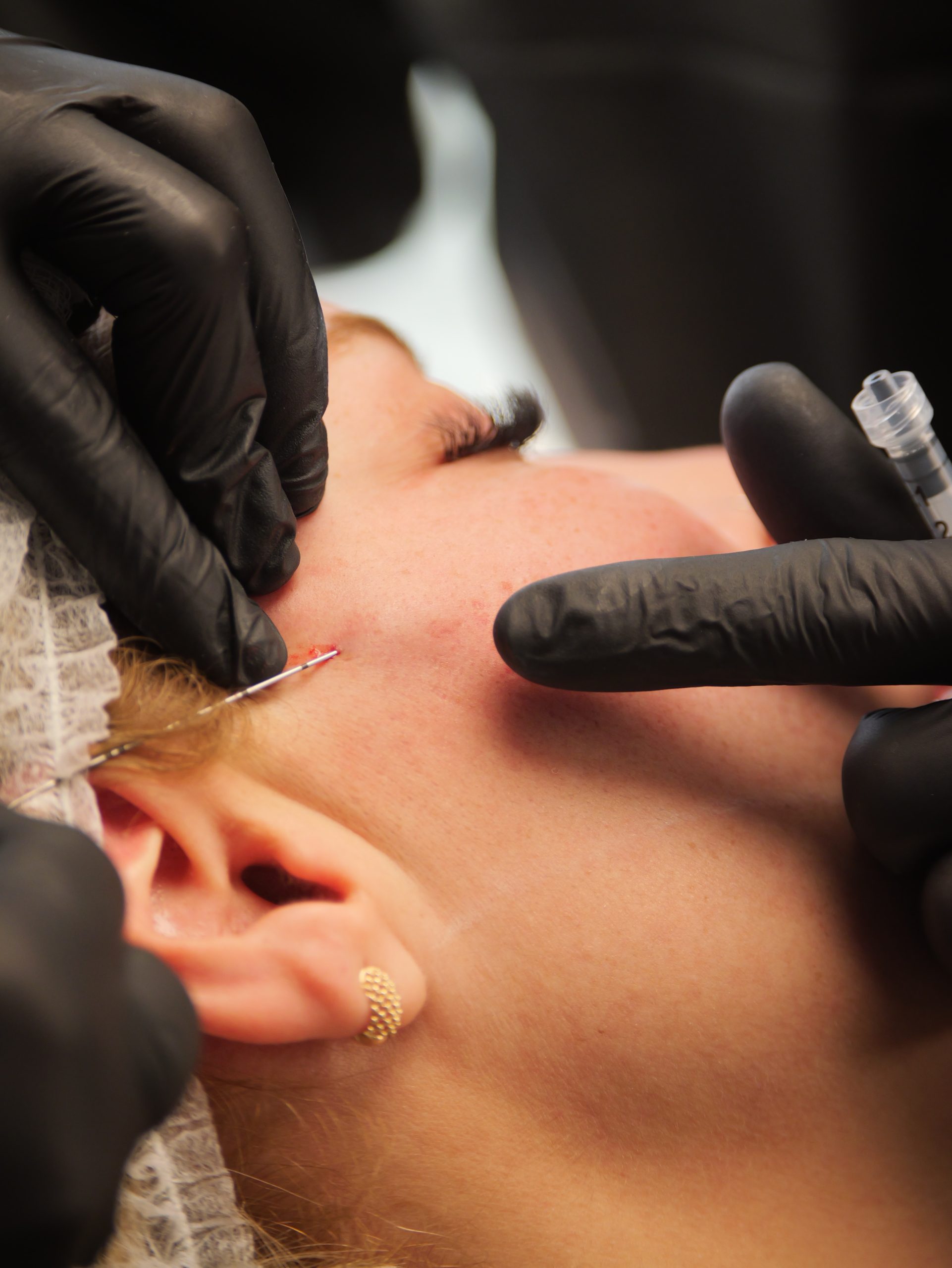 Peeling SKIMS - Dr. José Henrique - mentoria - curso - imersao, presencial, sp sp sp