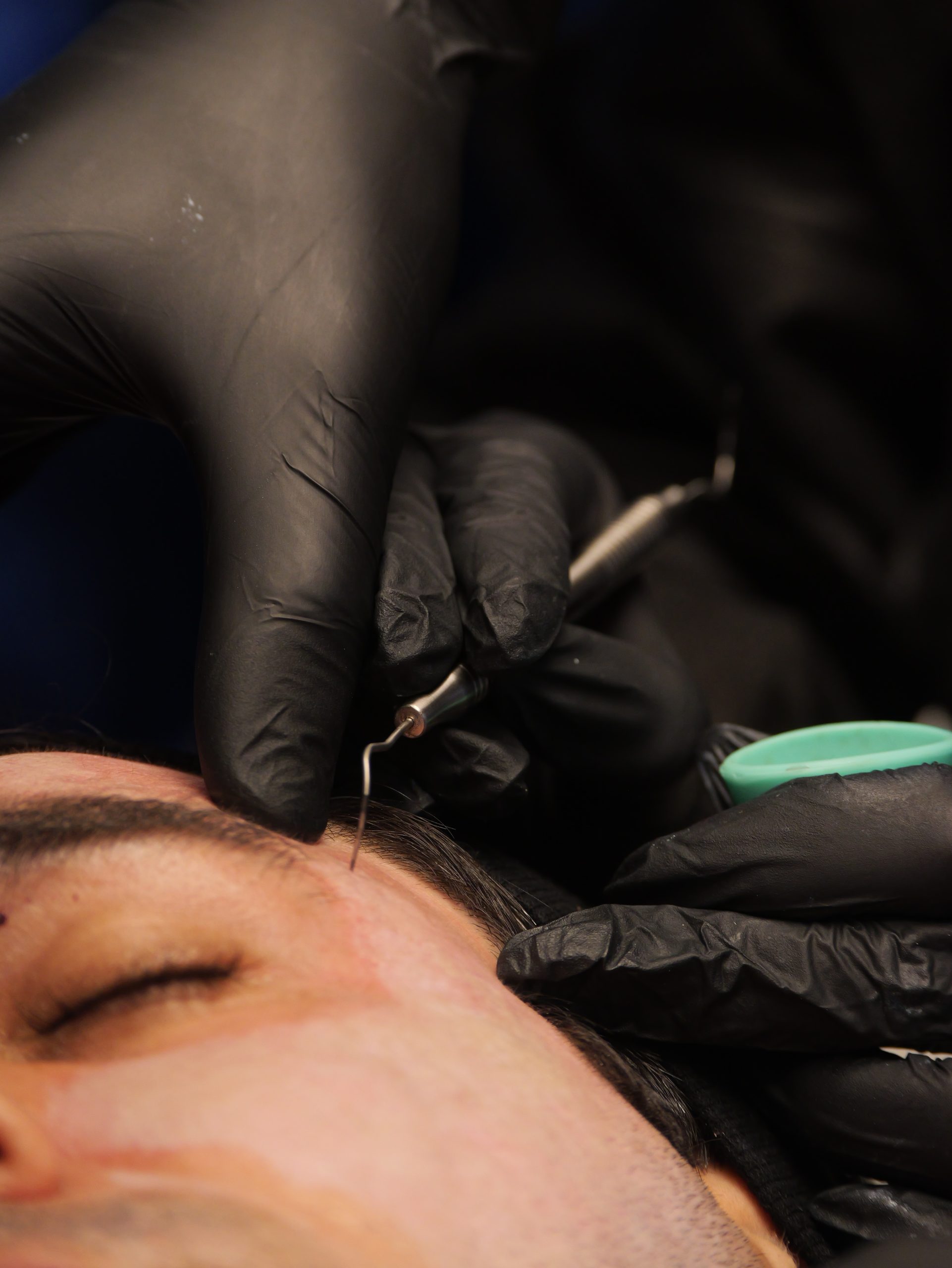 Peeling SKIMS - Dr. José Henrique - mentoria - curso - imersao - sp - sp