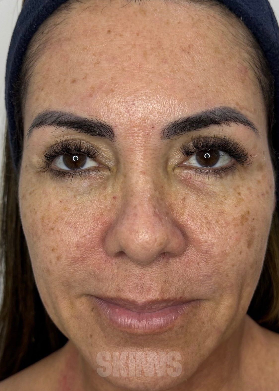peeling para o rosto SKIMS - Resultados 1