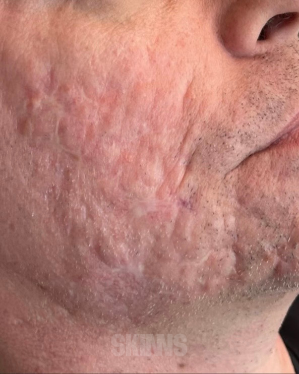 peeling para o rosto SKIMS - Resultados 11