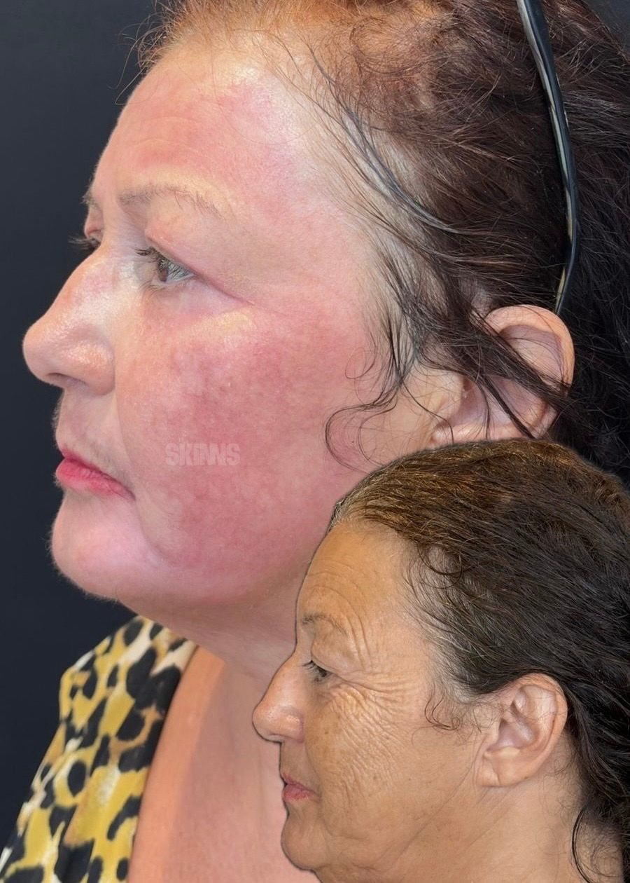 peeling para o rosto SKIMS - Resultados 19
