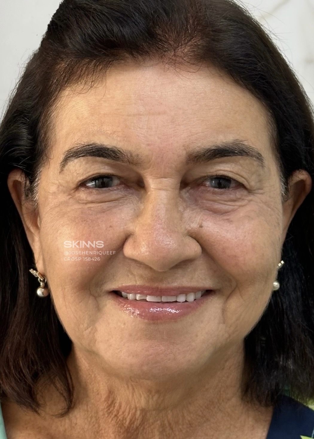 SKIMS Rejuvenescimento: Resultados - 28