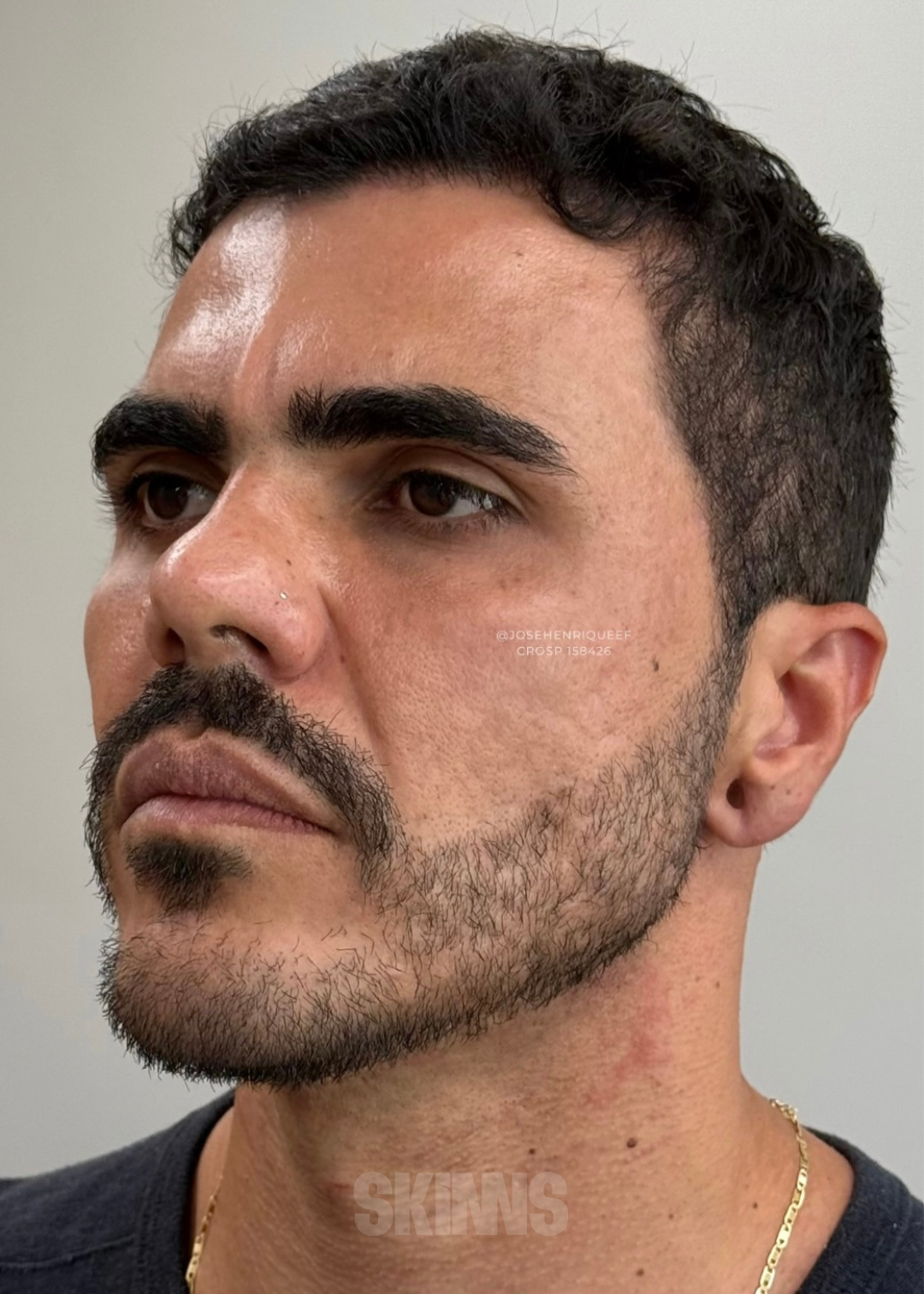 resultados método skims - peeling 2.1