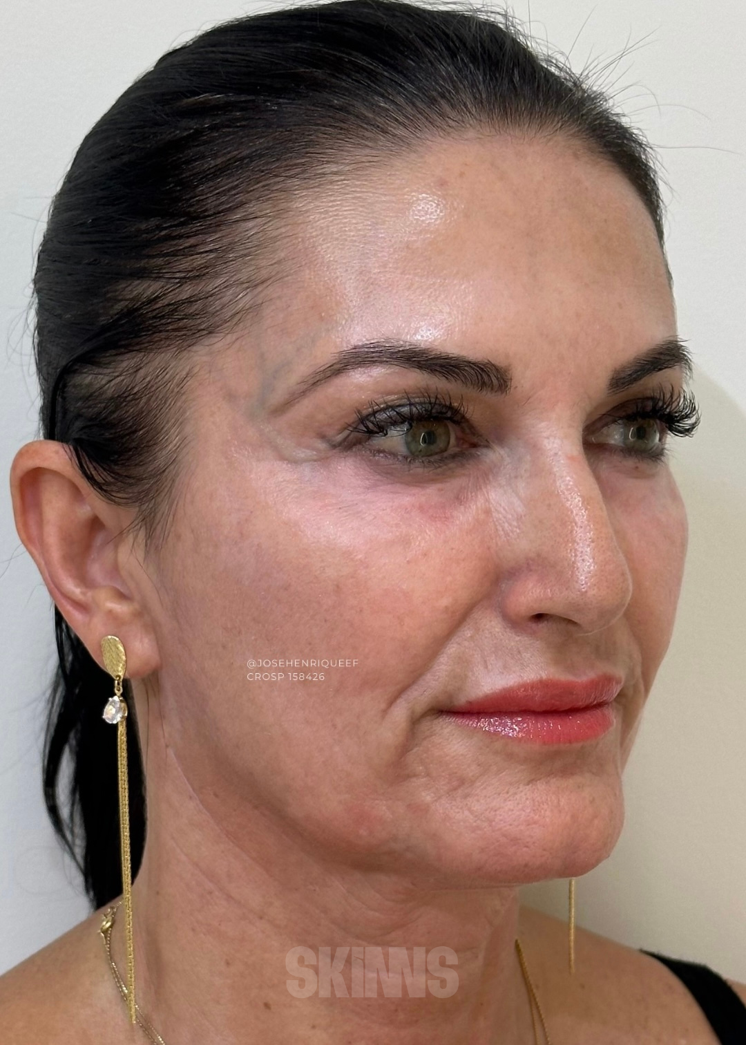 resultados método skims - peeling 3.1