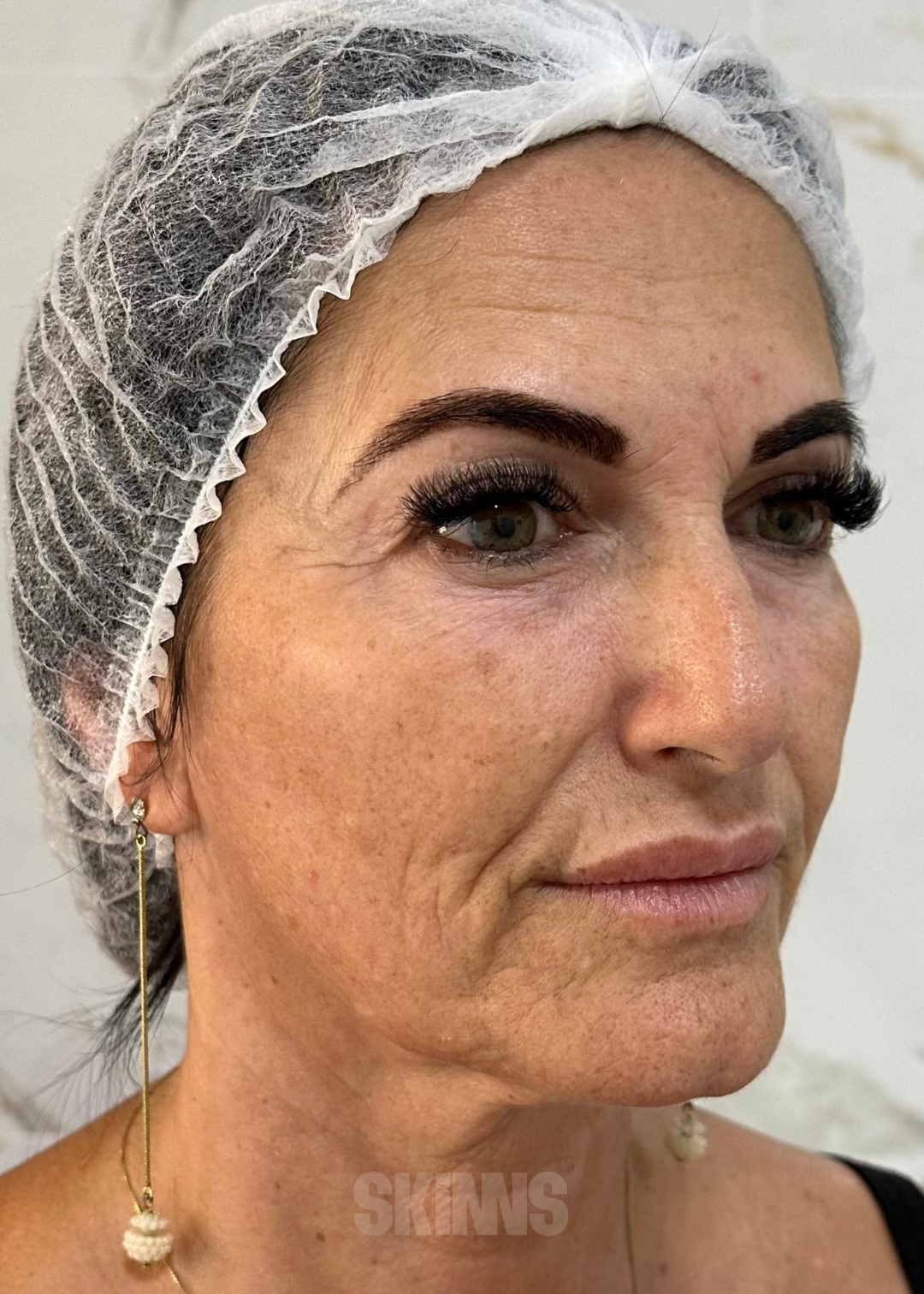 resultados método skims - peeling 3