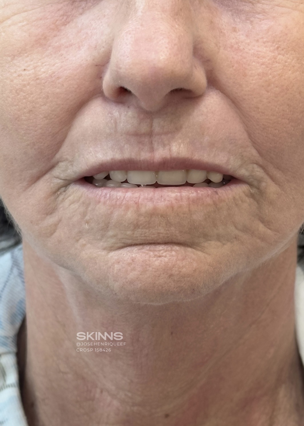 resultados método skims - peeling 4.1