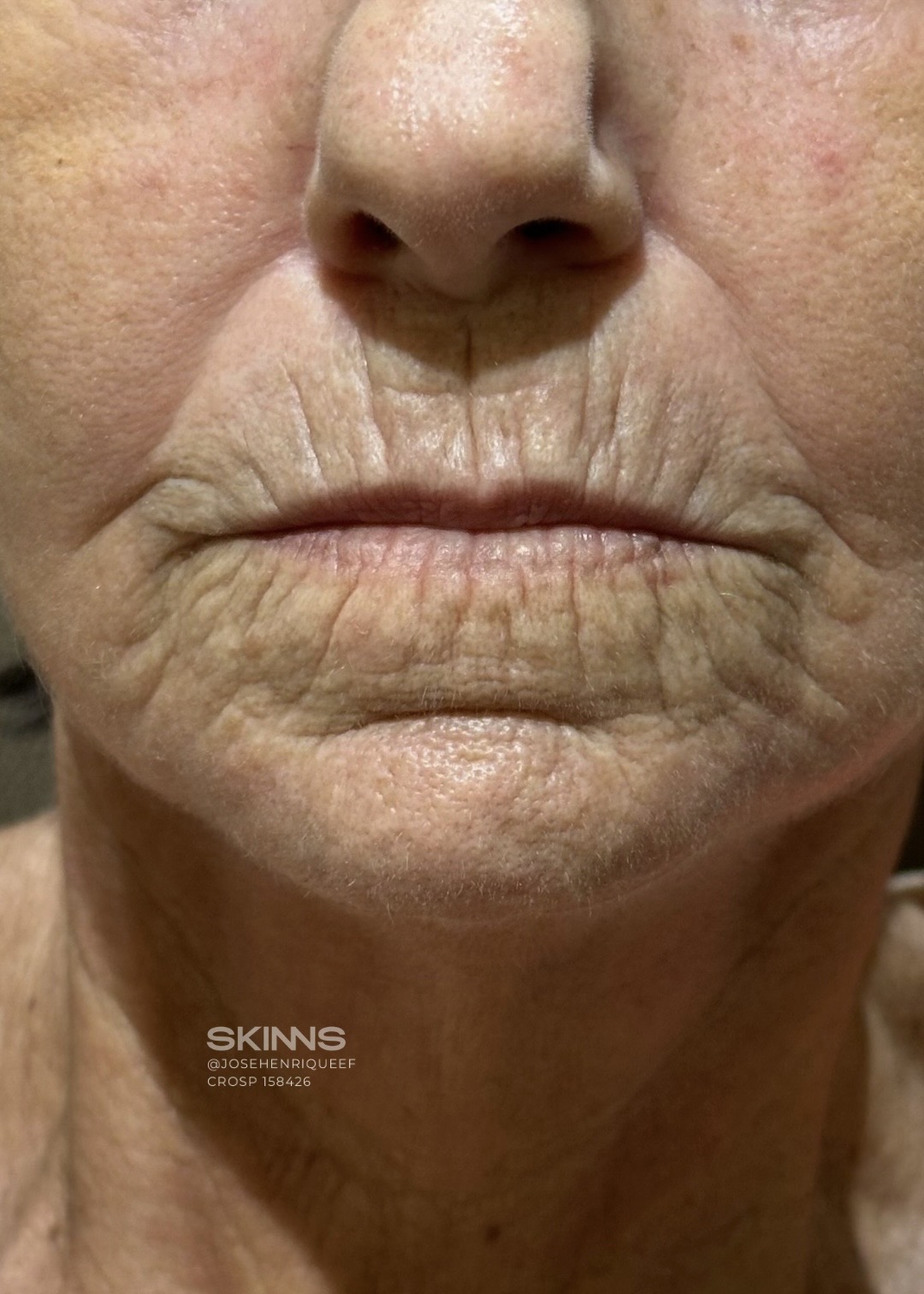resultados método skims - peeling 4