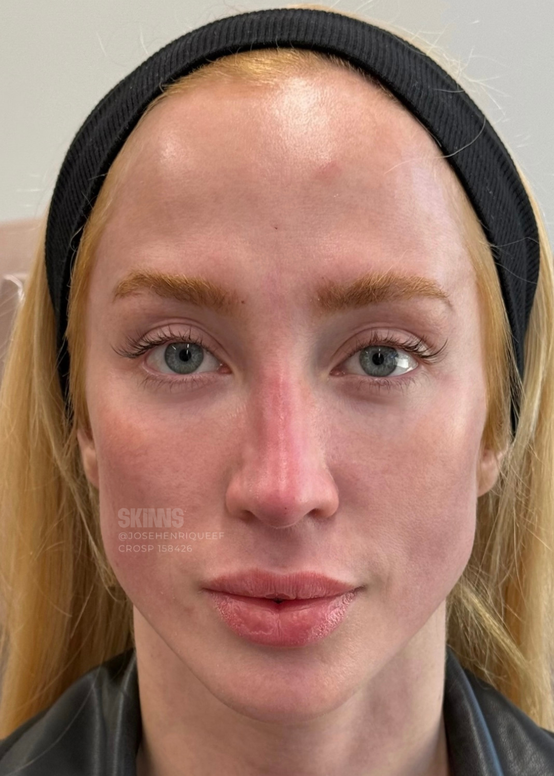 resultados método skims - peeling 6.1