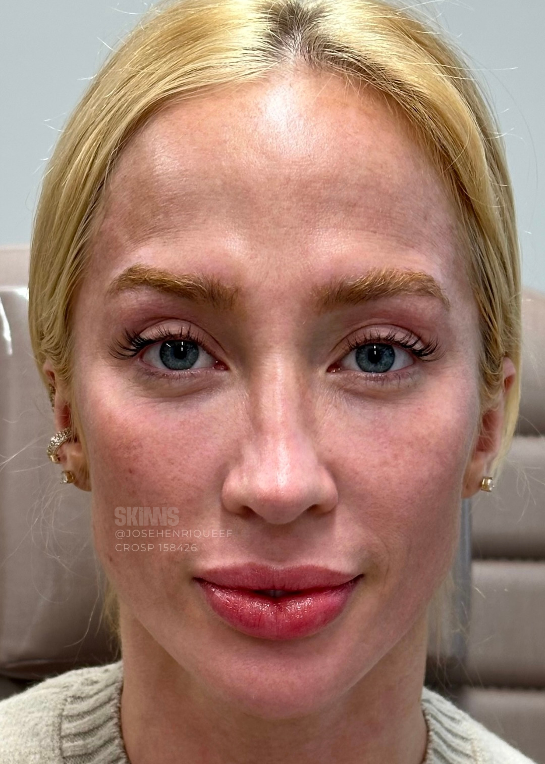 resultados método skims - peeling 6