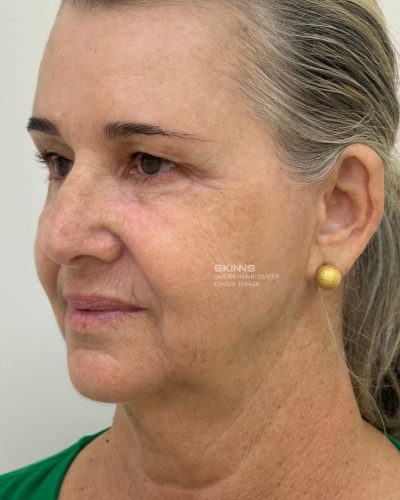 SKIMS-Rejuvenescimento-Resultados.zip-17 SKIMS-Rejuvenescimento-Resultados.zip-17